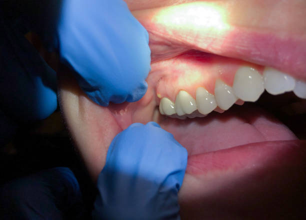 Best Emergency Dentist for Knocked-Out Tooth in Cherryville, NC